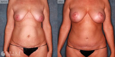 Mommy Makeover Before & After Gallery - Patient 428414 - Image 1