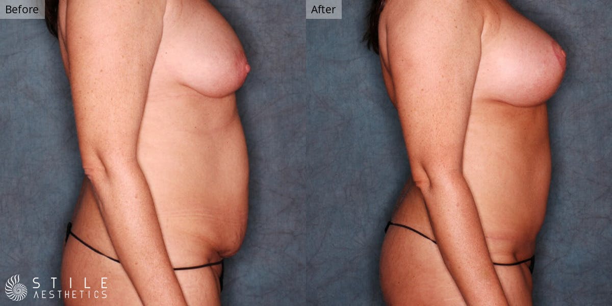 Mommy Makeover Before & After Gallery - Patient 428414 - Image 2