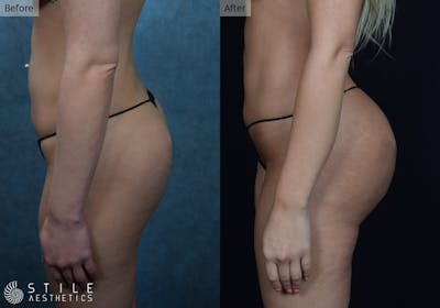 Brazilian Butt Lift Before & After Gallery - Patient 280795 - Image 1