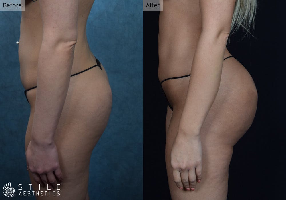 Brazilian Butt Lift Before & After Gallery - Patient 280795 - Image 1