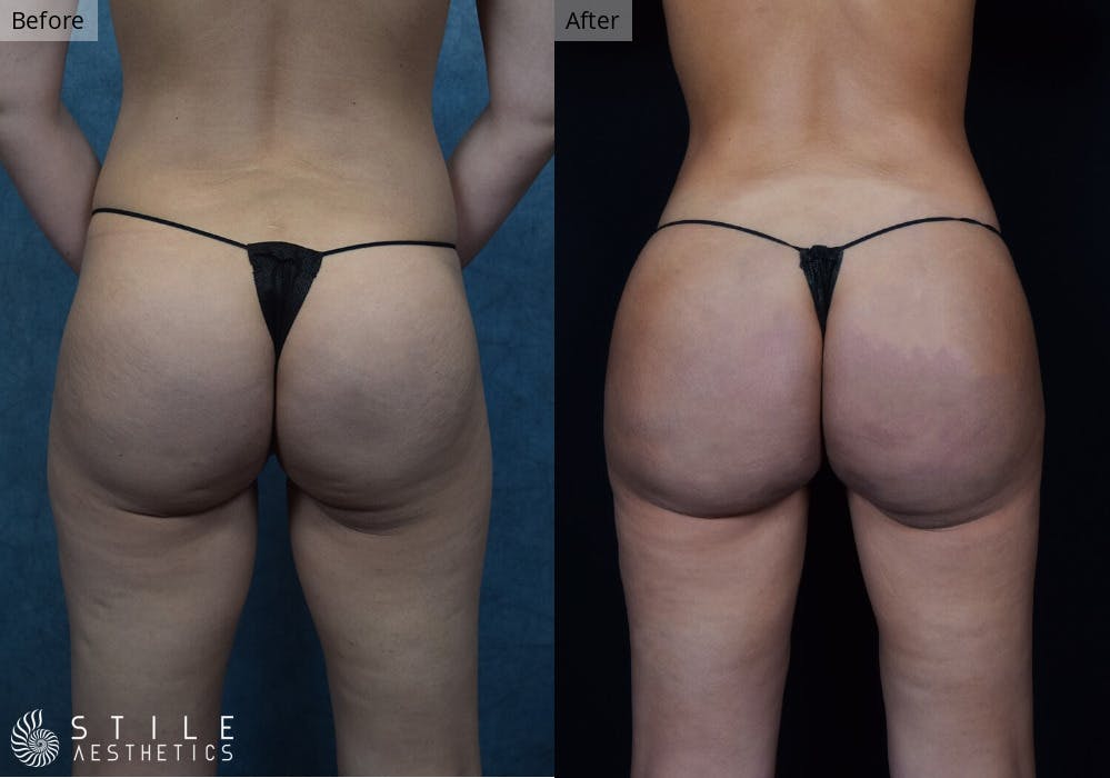 Brazilian Butt Lift Before & After Gallery - Patient 280795 - Image 2