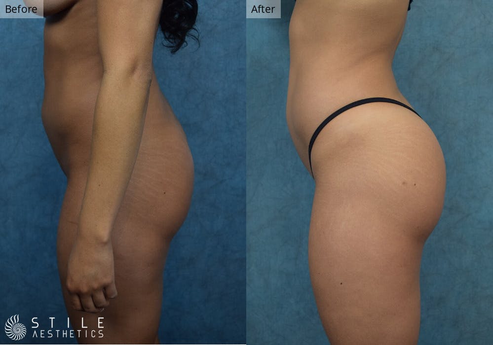 Brazilian Butt Lift Before & After Gallery - Patient 391451 - Image 1