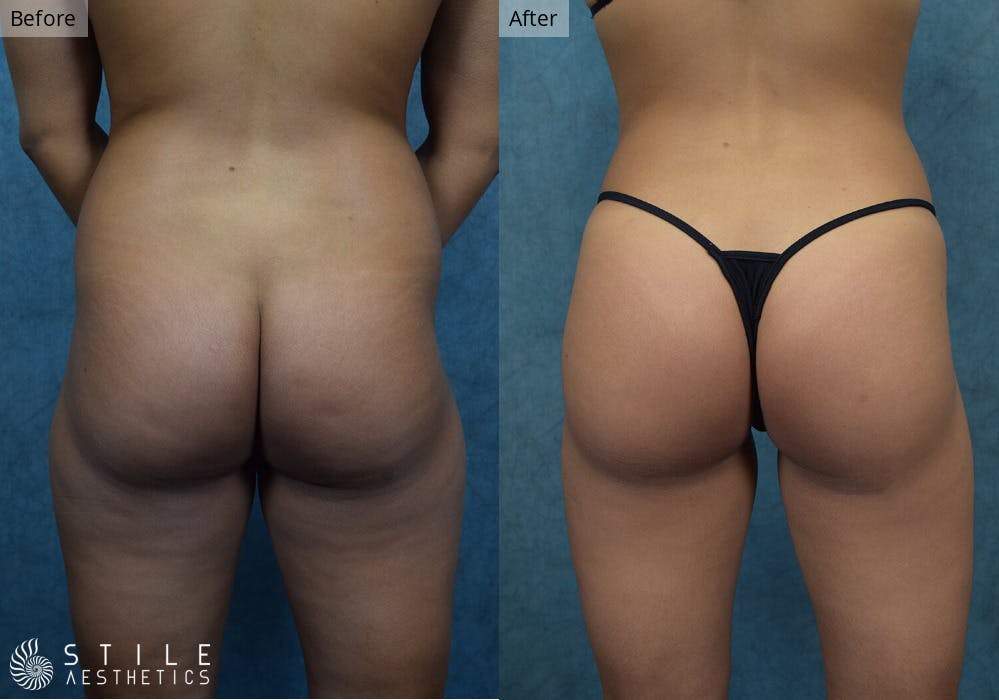 Brazilian Butt Lift Before & After Gallery - Patient 391451 - Image 2