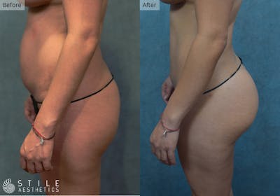 Brazilian Butt Lift Before & After Gallery - Patient 307424 - Image 1