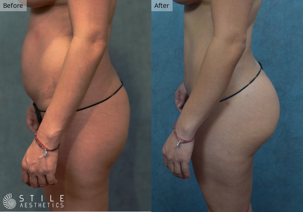 Brazilian Butt Lift Before & After Gallery - Patient 307424 - Image 1