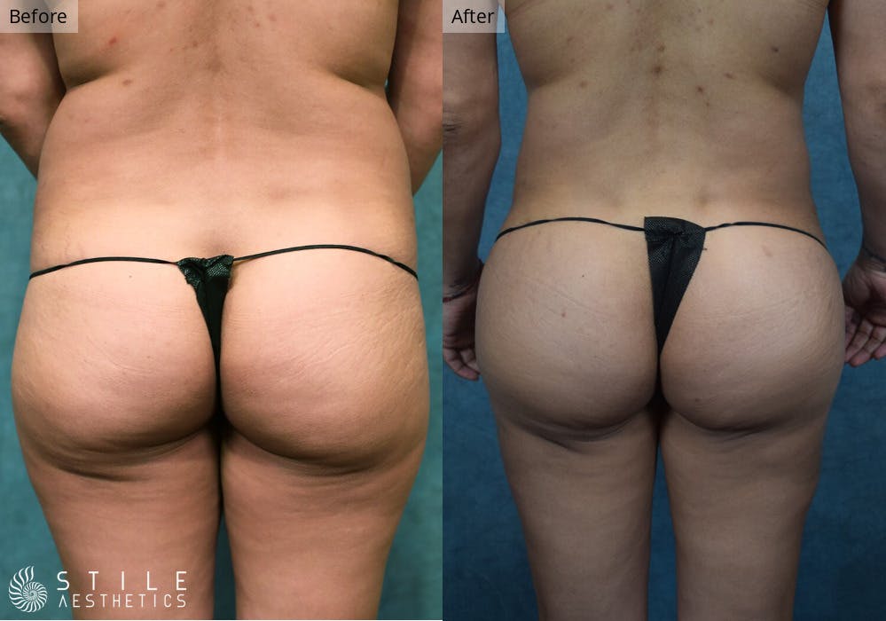 Brazilian Butt Lift Before & After Gallery - Patient 307424 - Image 2