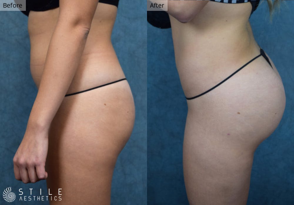 Brazilian Butt Lift Before & After Gallery - Patient 151724 - Image 1