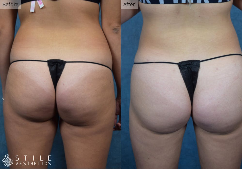 Brazilian Butt Lift Before & After Gallery - Patient 151724 - Image 2