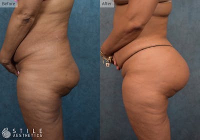Brazilian Butt Lift Before & After Gallery - Patient 718589 - Image 1