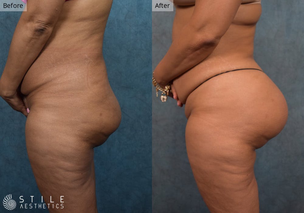 Brazilian Butt Lift Before & After Gallery - Patient 718589 - Image 1