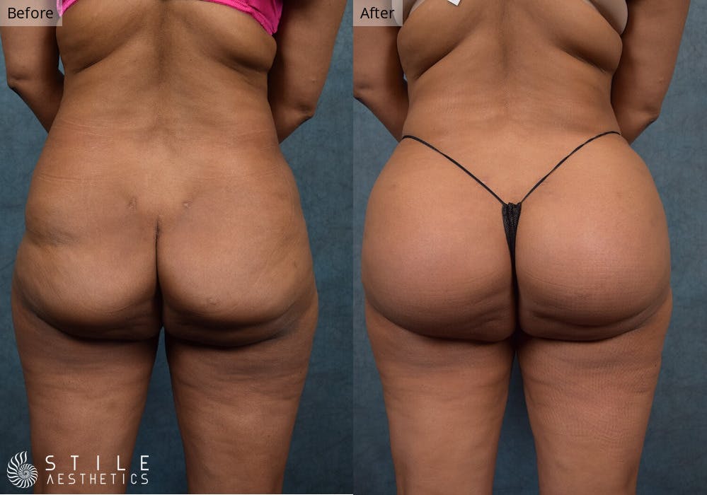 Brazilian Butt Lift Before & After Gallery - Patient 718589 - Image 2