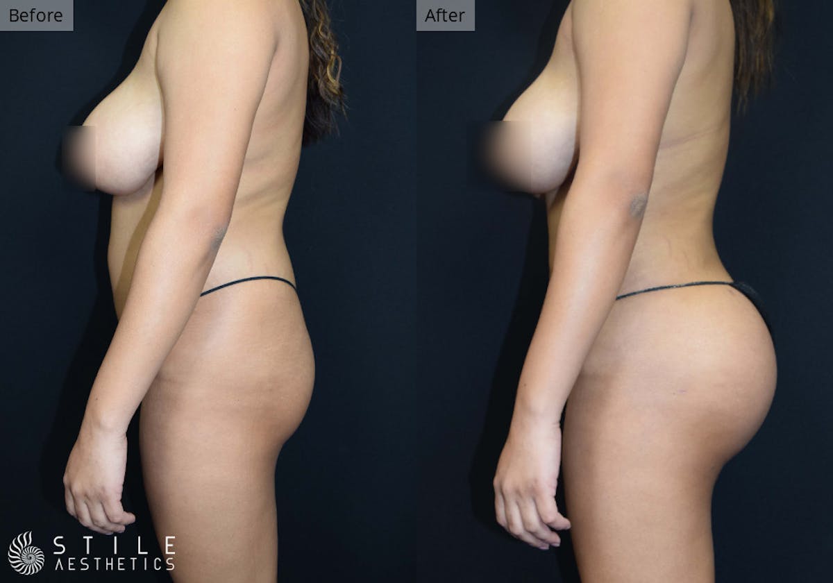 Brazilian Butt Lift Before & After Gallery - Patient 299780 - Image 1