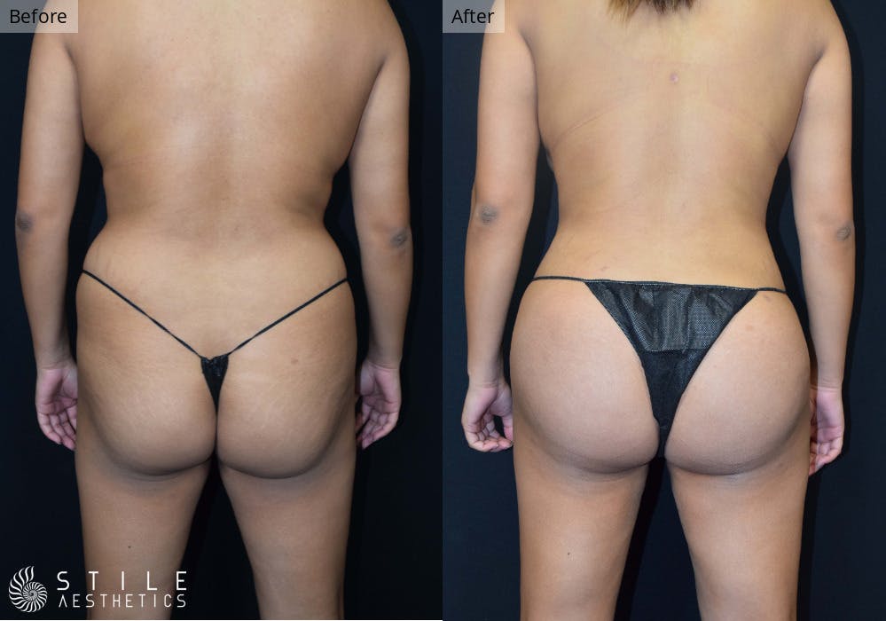 Brazilian Butt Lift Before & After Gallery - Patient 299780 - Image 2