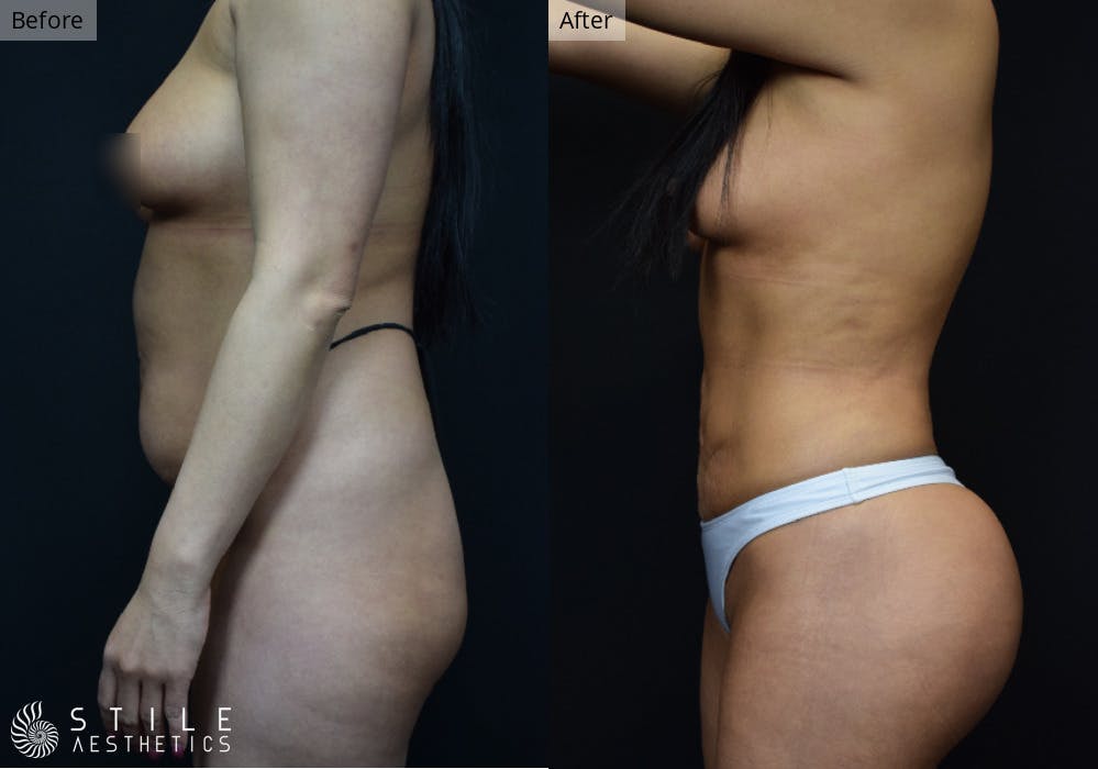 Brazilian Butt Lift Before & After Gallery - Patient 215008 - Image 1
