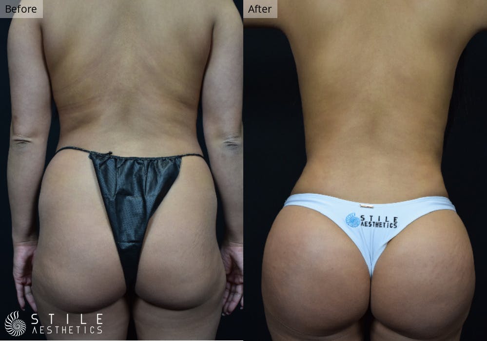 Brazilian Butt Lift Before & After Gallery - Patient 215008 - Image 2