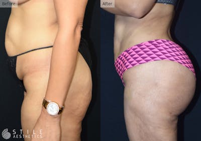 Brazilian Butt Lift Before & After Gallery - Patient 428682 - Image 1