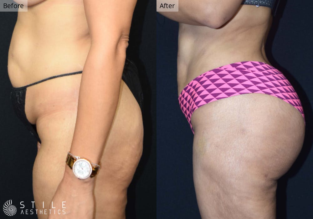 Brazilian Butt Lift Before & After Gallery - Patient 428682 - Image 1
