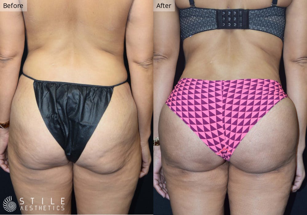 Brazilian Butt Lift Before & After Gallery - Patient 428682 - Image 2