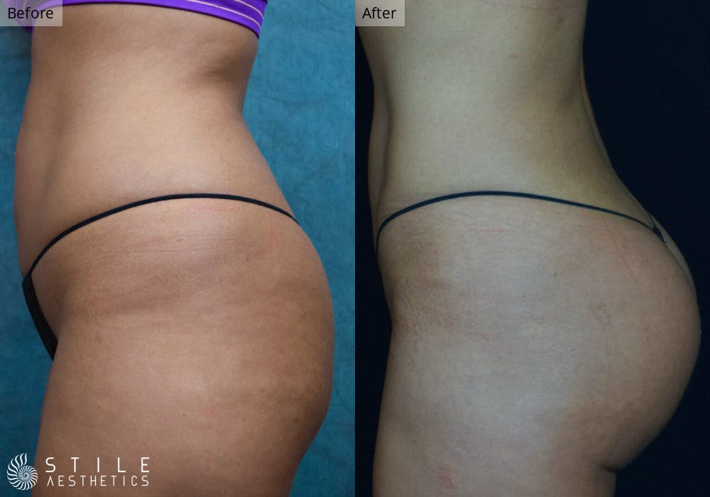 Brazilian Butt Lift Before & After Gallery - Patient 254420 - Image 1