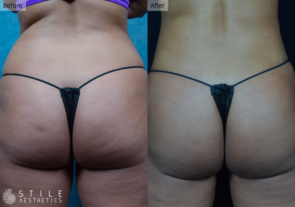 Brazilian Butt Lift Before & After Gallery - Patient 254420 - Image 2
