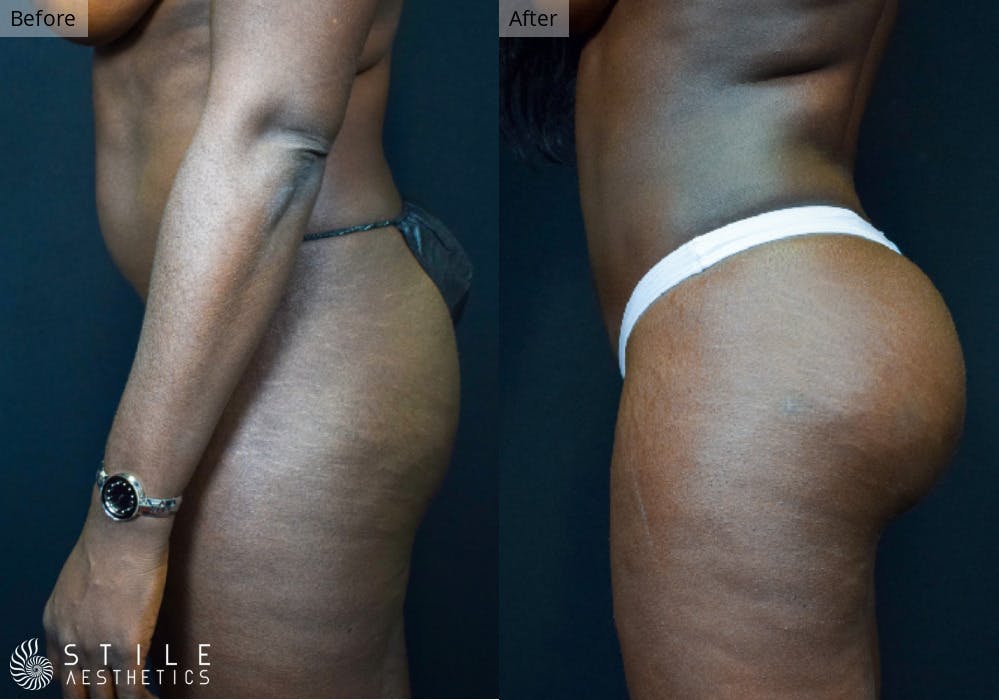 Brazilian Butt Lift Before & After Gallery - Patient 313238 - Image 1
