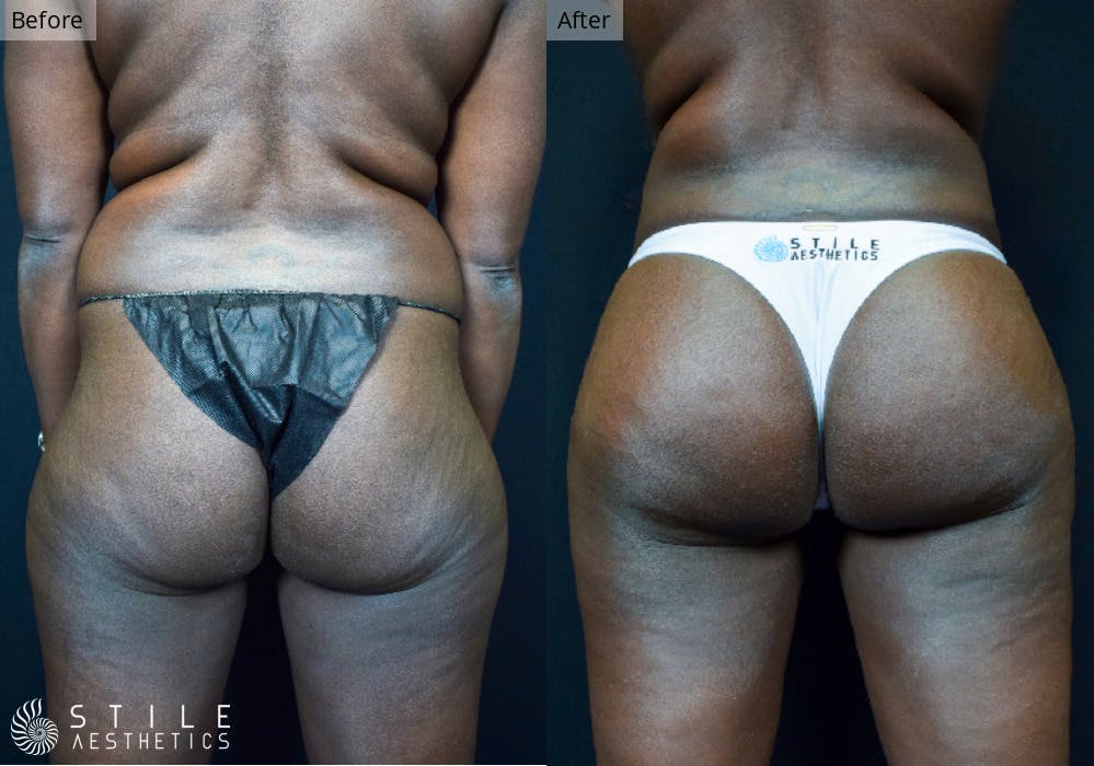Brazilian Butt Lift Before & After Gallery - Patient 313238 - Image 2