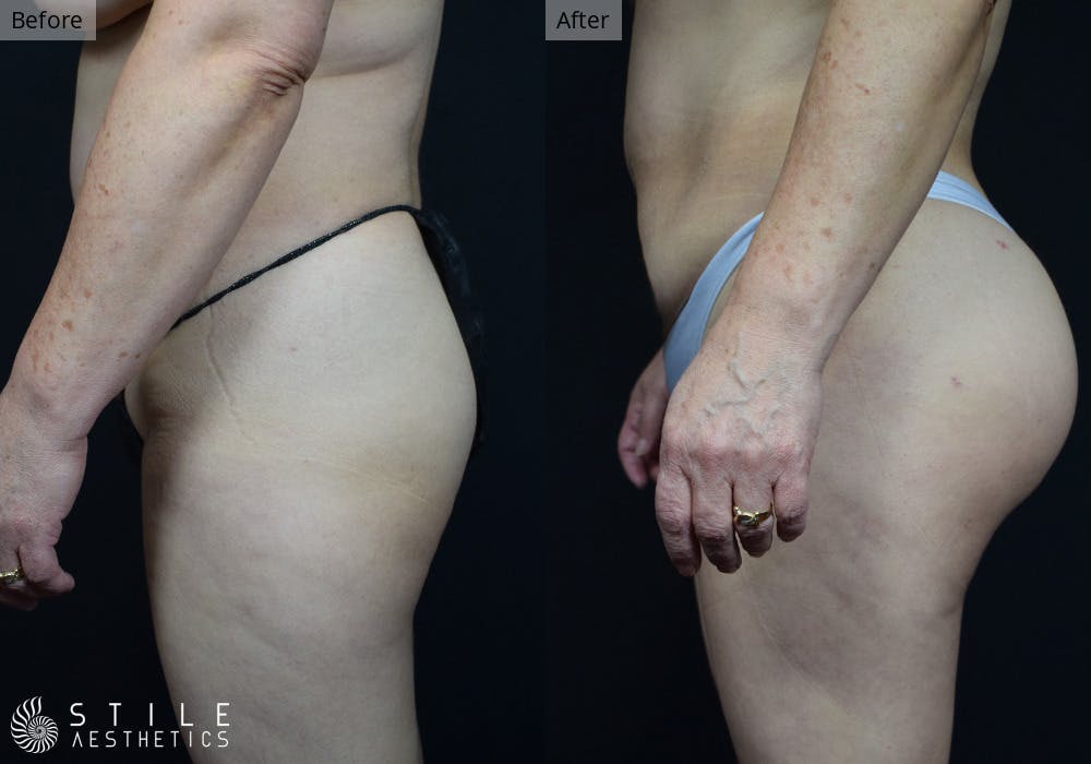 Brazilian Butt Lift Before & After Gallery - Patient 254614 - Image 1