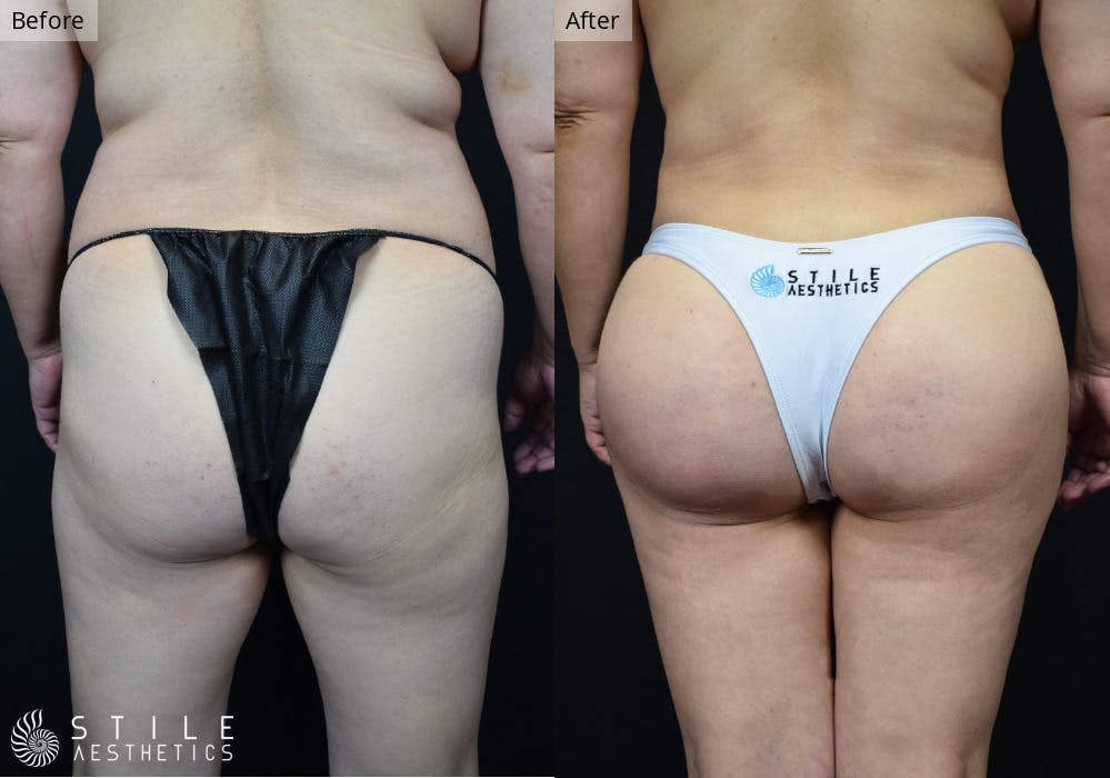 Brazilian Butt Lift Before & After Gallery - Patient 254614 - Image 2