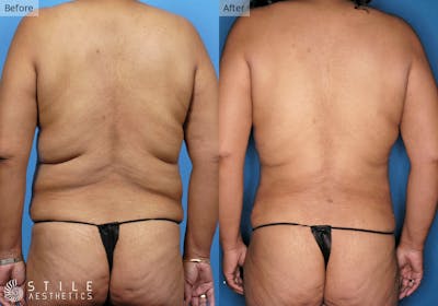 Liposuction Before & After Gallery - Patient 493658 - Image 1
