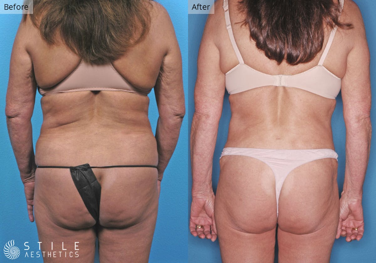 Liposuction Before & After Gallery - Patient 173748 - Image 1