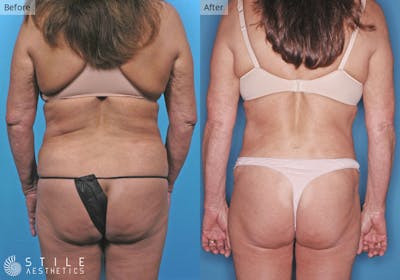 Liposuction Before & After Gallery - Patient 173748 - Image 1