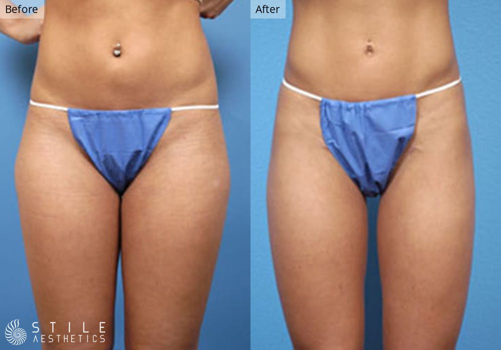 Liposuction Before & After Gallery - Patient 388135 - Image 1
