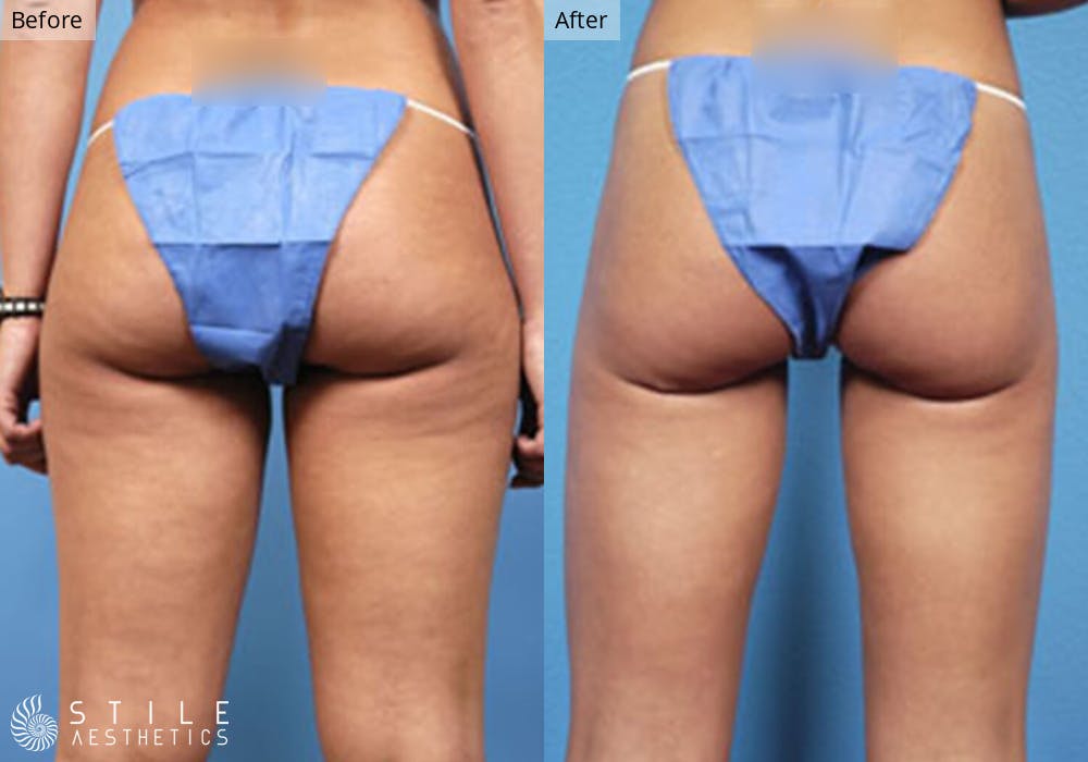 Liposuction Before & After Gallery - Patient 388135 - Image 2