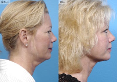 Liposuction Before & After Gallery - Patient 408145 - Image 1