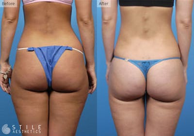 Liposuction Before & After Gallery - Patient 999900 - Image 1