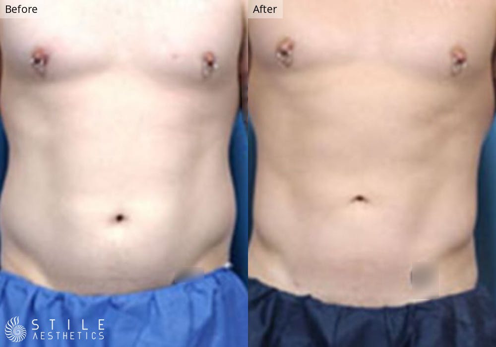 Liposuction Before & After Gallery - Patient 401985 - Image 1