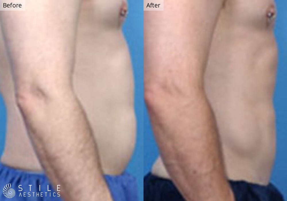 Liposuction Before & After Gallery - Patient 401985 - Image 2