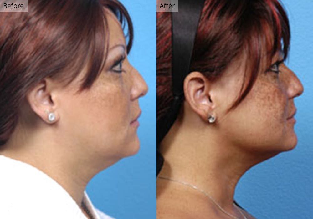 Liposuction Before & After Gallery - Patient 198156 - Image 1