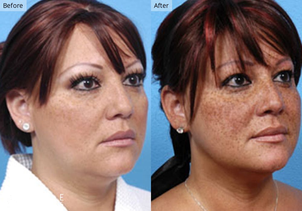 Liposuction Before & After Gallery - Patient 198156 - Image 2