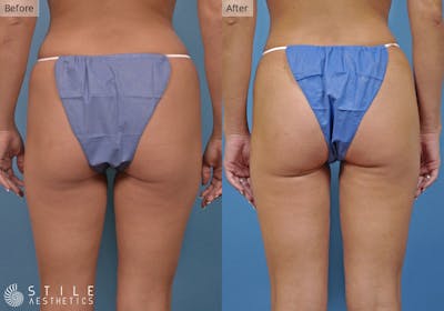 Liposuction Before & After Gallery - Patient 117845 - Image 1