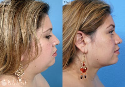 Liposuction Before & After Gallery - Patient 234164 - Image 1