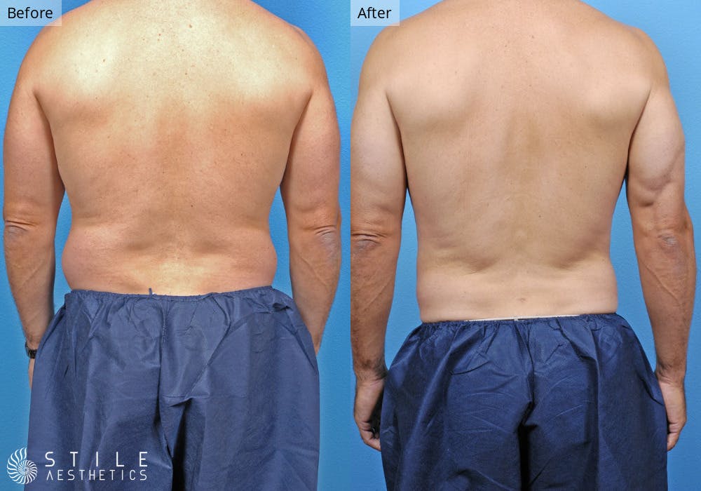 Liposuction Before & After Gallery - Patient 220665 - Image 1