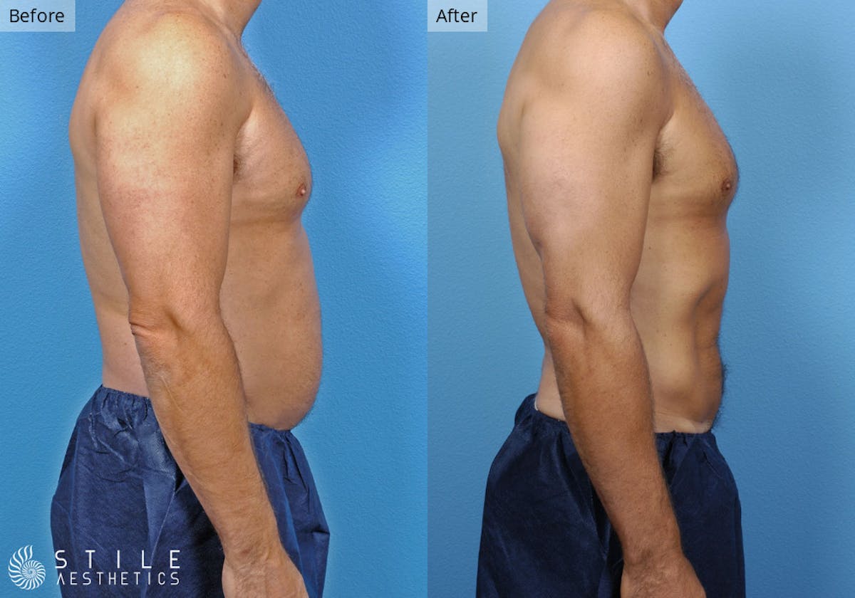 Liposuction Before & After Gallery - Patient 220665 - Image 2