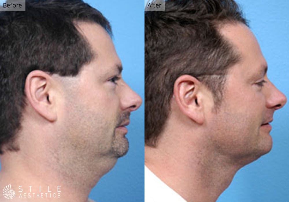 Liposuction Before & After Gallery - Patient 246585 - Image 1