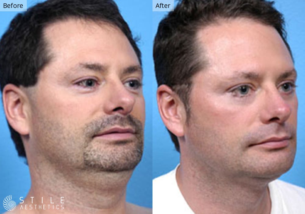 Liposuction Before & After Gallery - Patient 246585 - Image 2