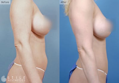Liposuction Before & After Gallery - Patient 327887 - Image 1
