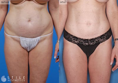 Liposuction Before & After Gallery - Patient 192887 - Image 1