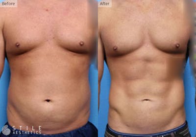 Liposuction Before & After Gallery - Patient 317611 - Image 1