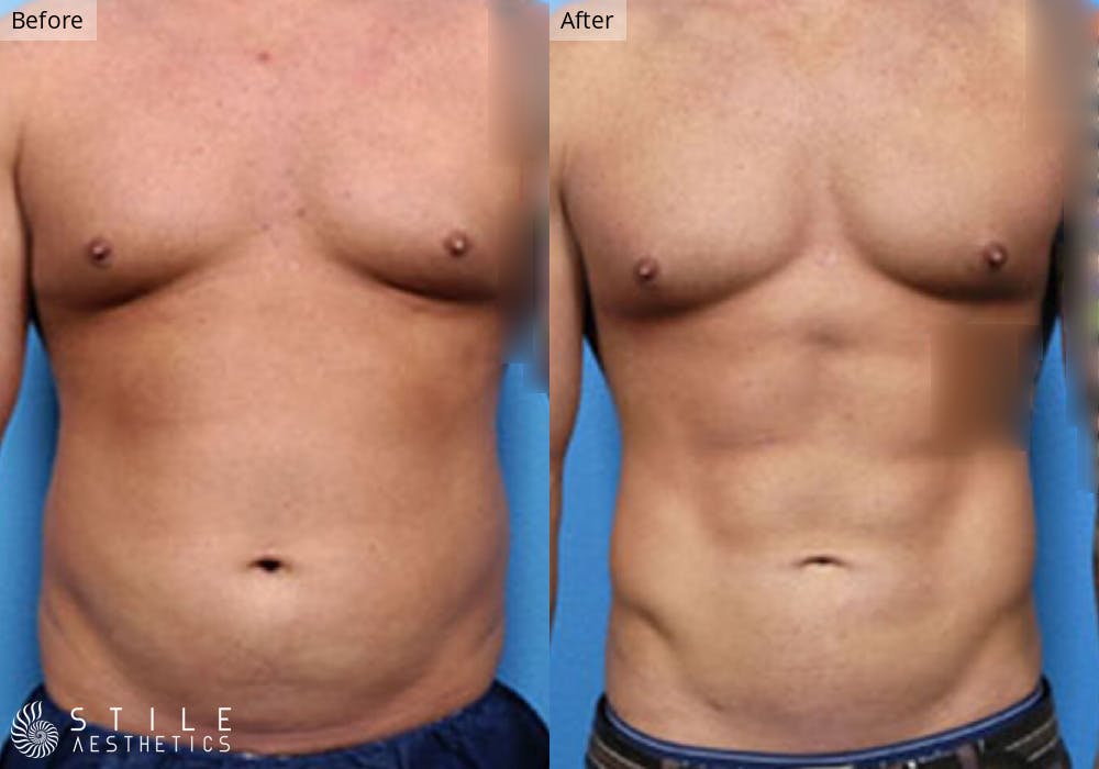 Liposuction Before & After Gallery - Patient 317611 - Image 1