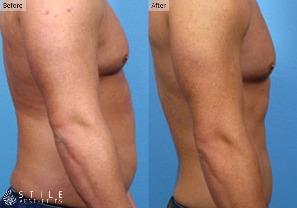 Liposuction Before & After Gallery - Patient 317611 - Image 2